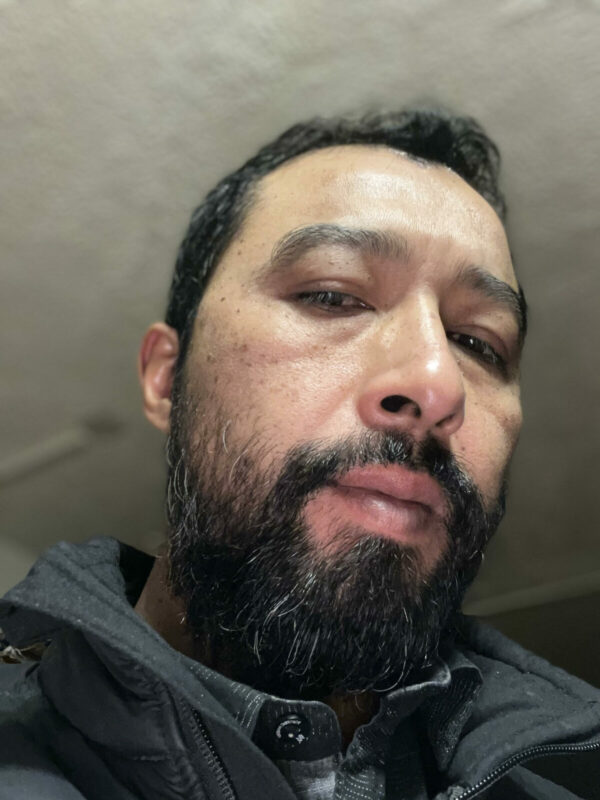 Minoxidil beard before and after