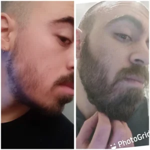 Homme qui montre sa barbe apres l'utilisation du rouleau pour barbe pendant 3 mois