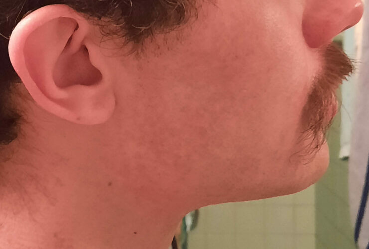 Barba afeitada (0 días)