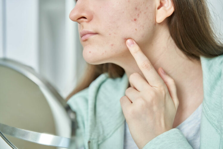 Woman with irritated skin due to beard