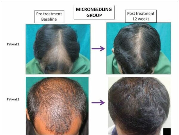 Estudio sobre el rodillo para barba y el minoxidil para la alopecia androgénica